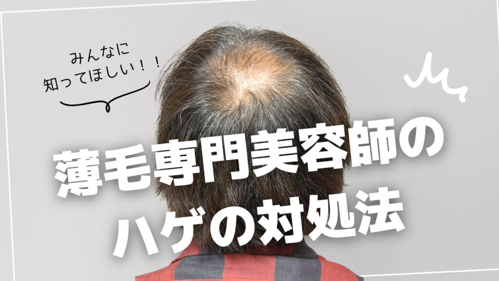 はげはどうしようもない?おすすめな対処法や主なはげの原因を紹介! 薄毛に悩む男性の為の美容室ならRELIVE - 薄毛に悩む男性のための完全個室美容室