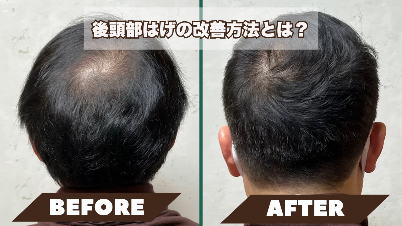後頭部がはげる原因は?つむじはげとの違いや改善・対策方法 薄毛に悩む男性の為の美容室ならRELIVE - 薄毛に悩む男性のための完全個室美容室