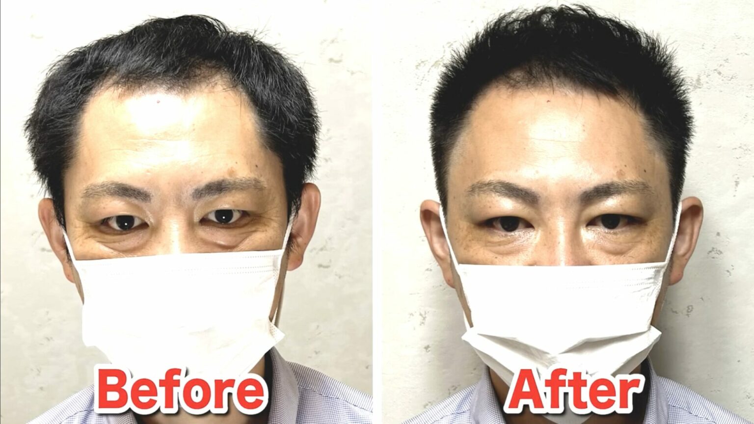 30代ではげてきた?はげる原因や対策・見分け方を徹底解説! 薄毛に悩む男性の為の美容室ならRELIVE - 薄毛に悩む男性のための完全個室美容室