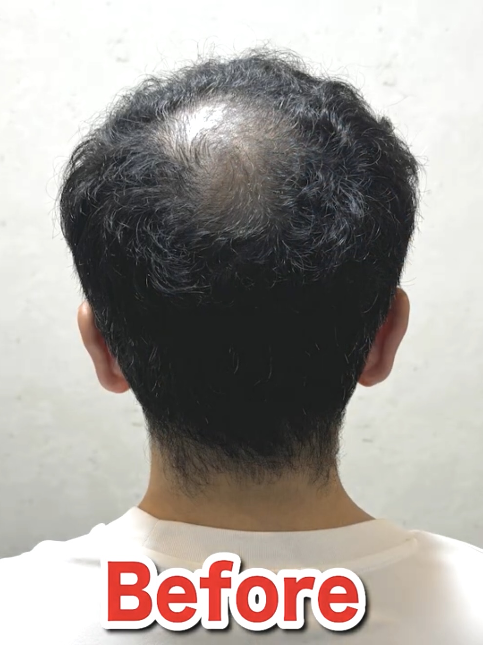 はげの種類や名前は？タイプ別のはげ方や特徴・原因までご紹介！ 薄毛に悩む男性の為の美容室ならRELIVE - 薄毛に悩む男性のための完全個室美容室