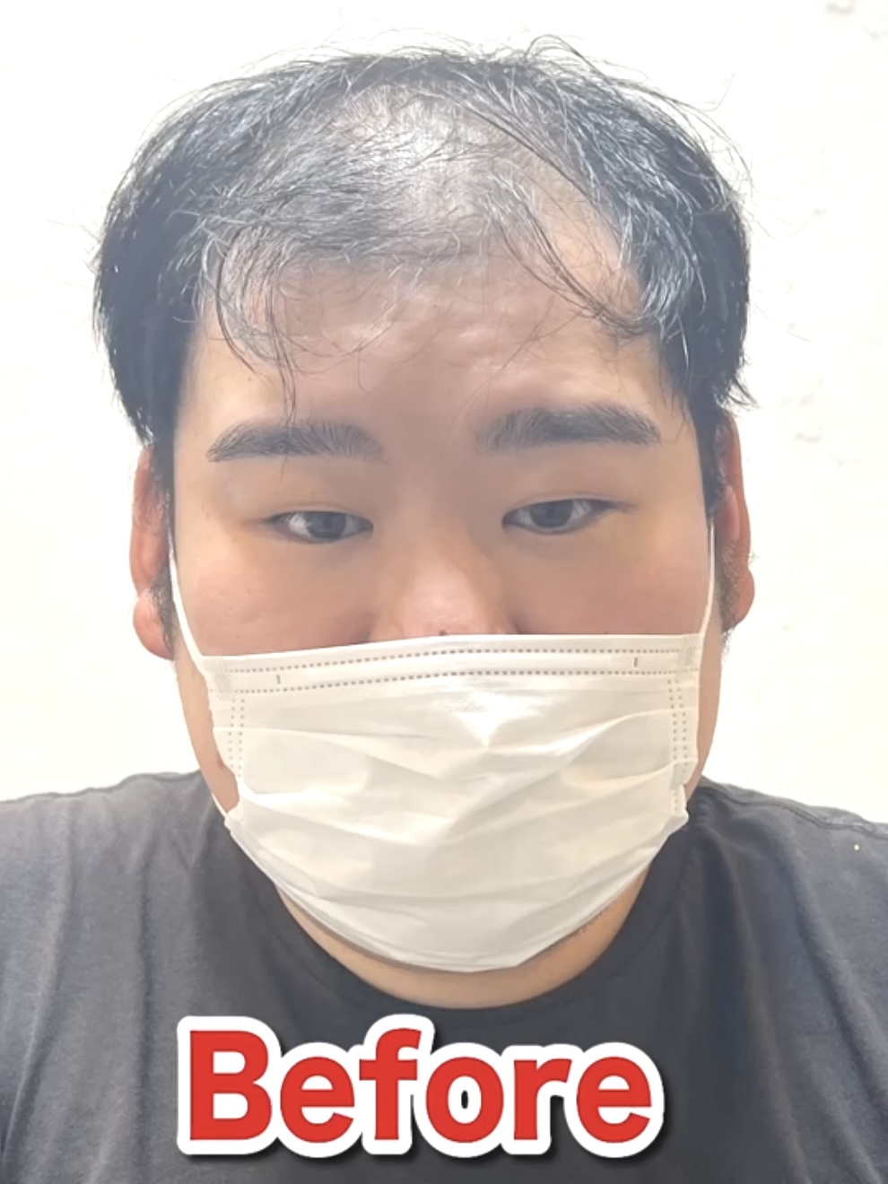 はげの種類や名前は？タイプ別のはげ方や特徴・原因までご紹介！ 薄毛に悩む男性の為の美容室ならRELIVE - 薄毛に悩む男性のための完全個室美容室