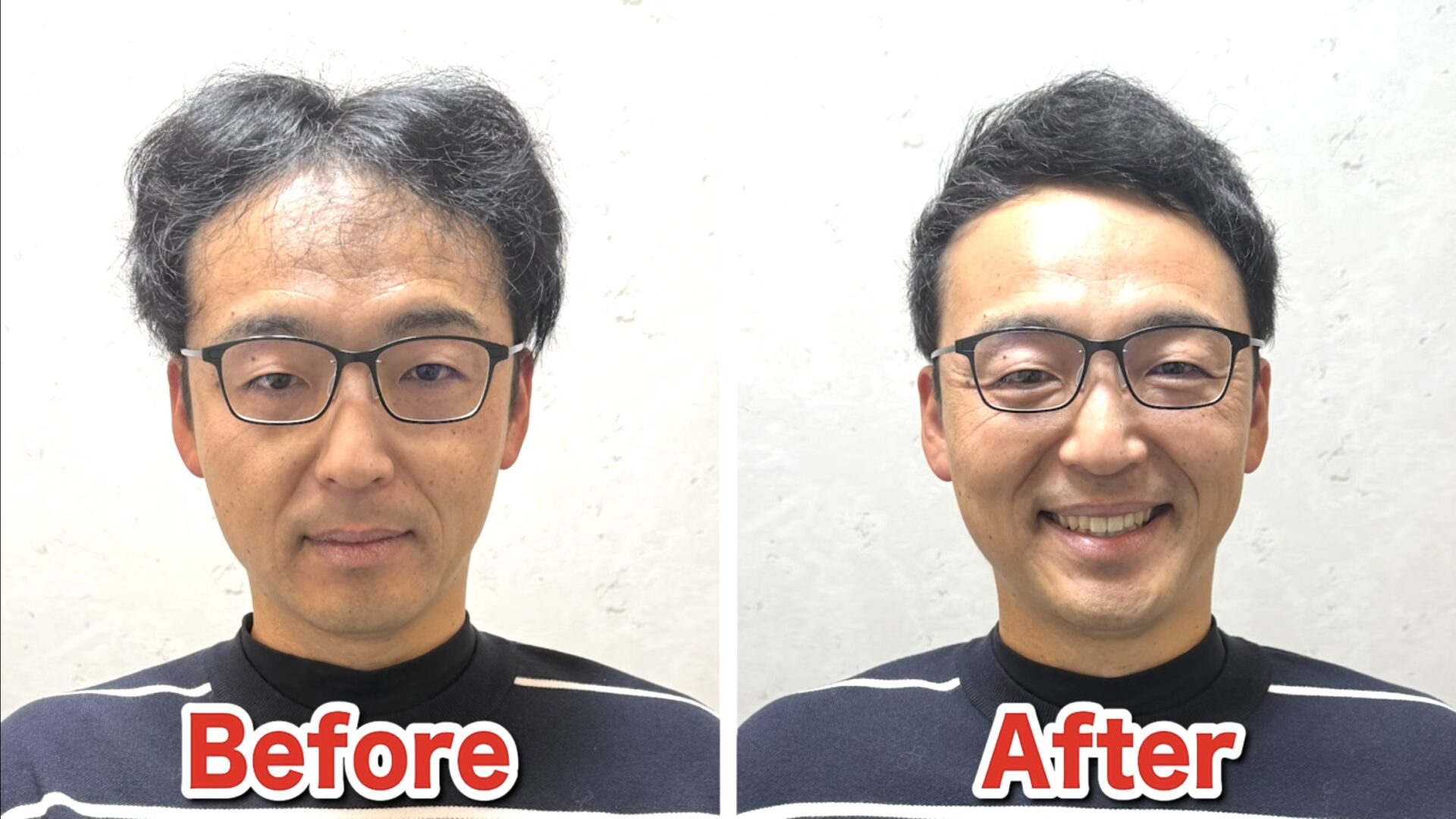 はげの種類や名前は?タイプ別のはげ方や特徴・原因までご紹介! 薄毛に悩む男性の為の美容室ならRELIVE - 薄毛に悩む男性のための完全個室美容室