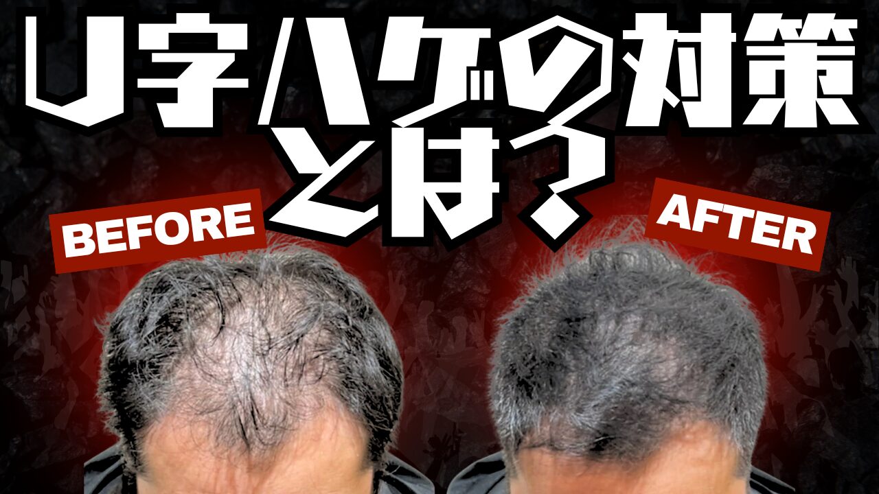 U字はげとは？主な基準や原因・対策方法まで徹底解説！ 薄毛に悩む男性の為の美容室ならRELIVE - 薄毛に悩む男性のための完全個室美容室