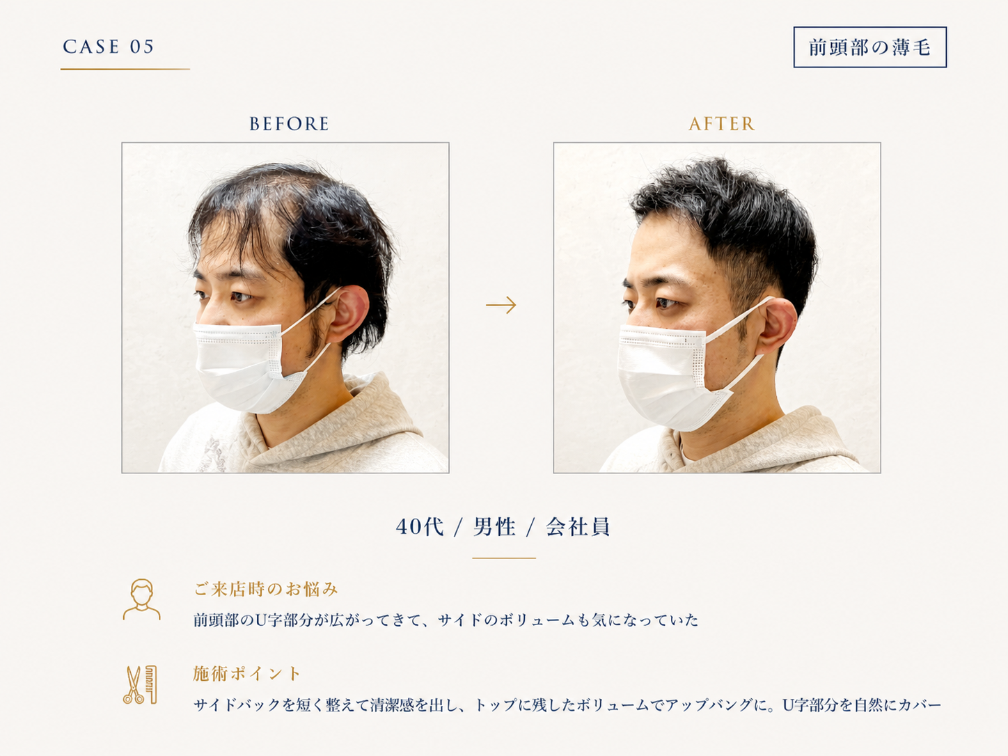 前頭部U字(生え際後退)の40代男性のBefore/After｜RELIVEのカット事例