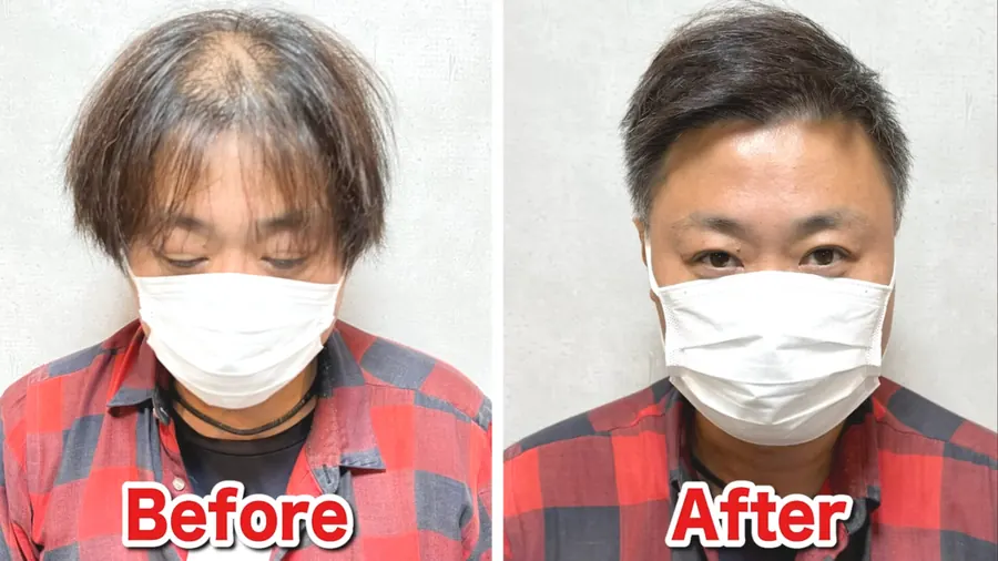 頭髮稀疏的男性剪髮前後對照——沒有植髮、沒有修圖