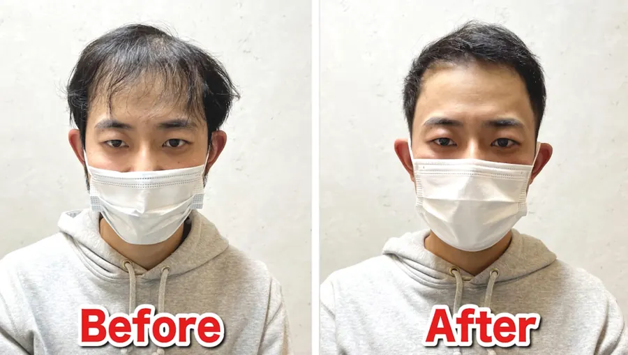M型禿剪髮前後對照案例