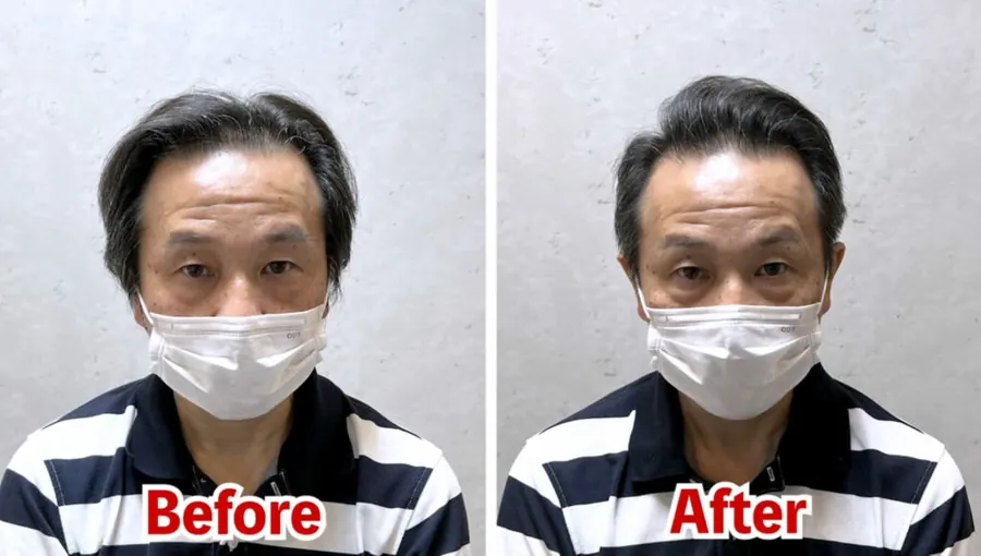後梳油頭修飾頭頂稀疏的改造案例