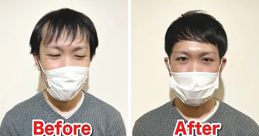 M型禿、髮際線後退的剪髮前後對照