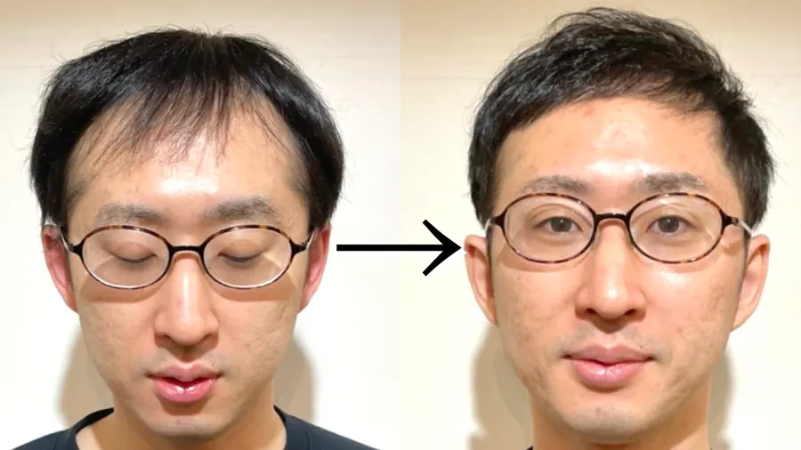 超短髮修飾M型禿的改造案例
