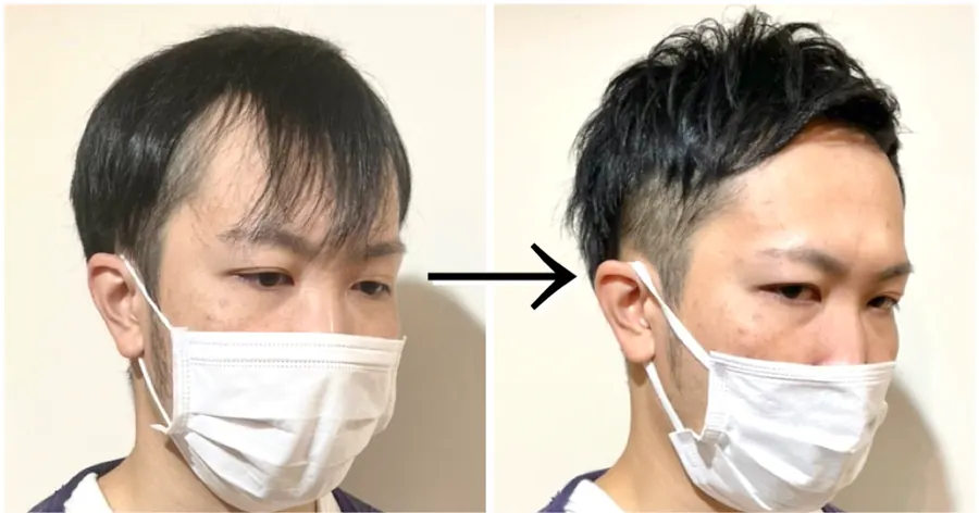 兩側推高短髮修飾M型禿的改造案例
