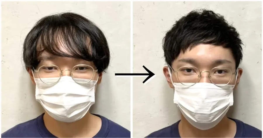 短版蓋頭修飾M型禿的改造案例