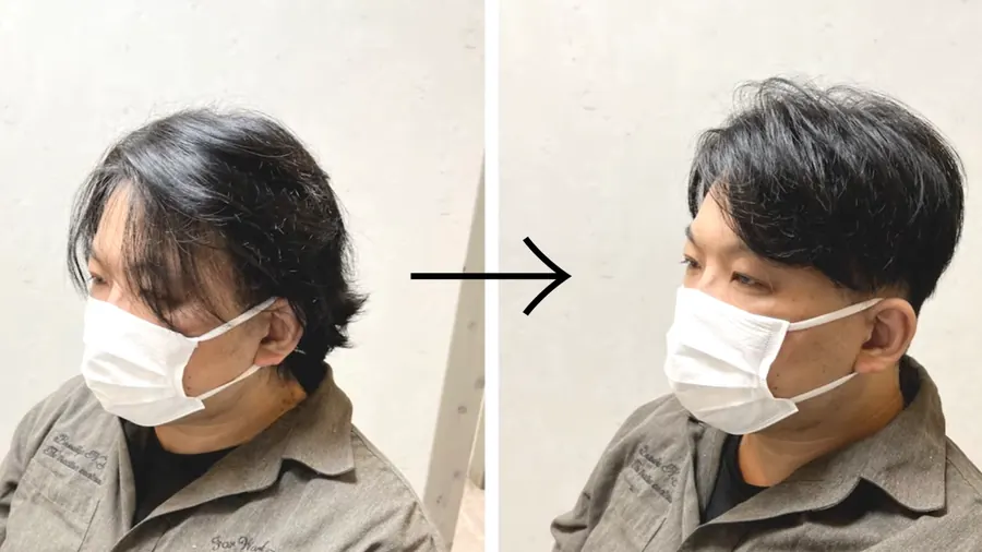 中分修飾M型禿的改造案例