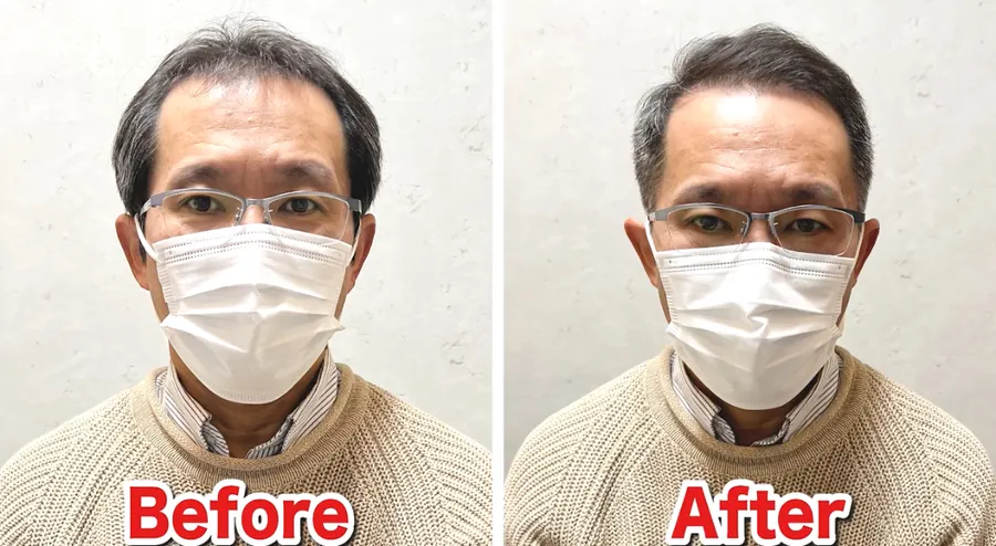 後梳油頭修飾40歲稀疏的改造案例