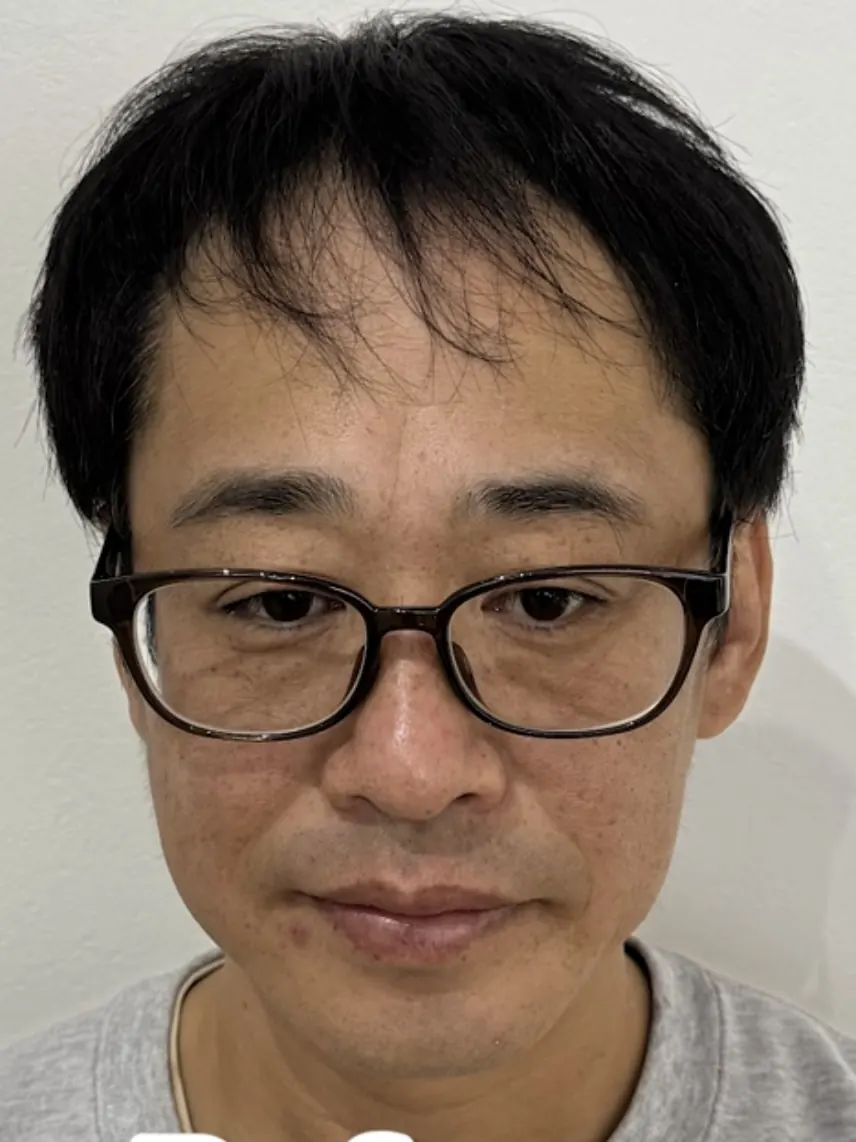 留長頭髮去蓋反而不自然