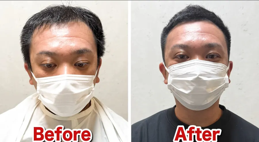 頭頂立體短髮修飾M型禿
