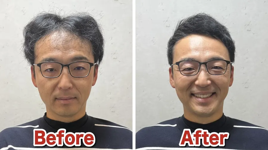 中分讓M型禿更明顯