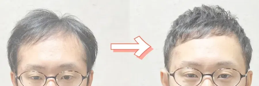 細軟髮男生的燙髮改造前後