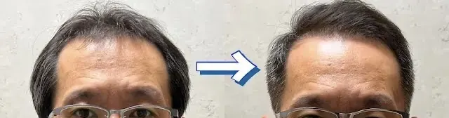 髮際線後移的男性梳油頭的改造前後