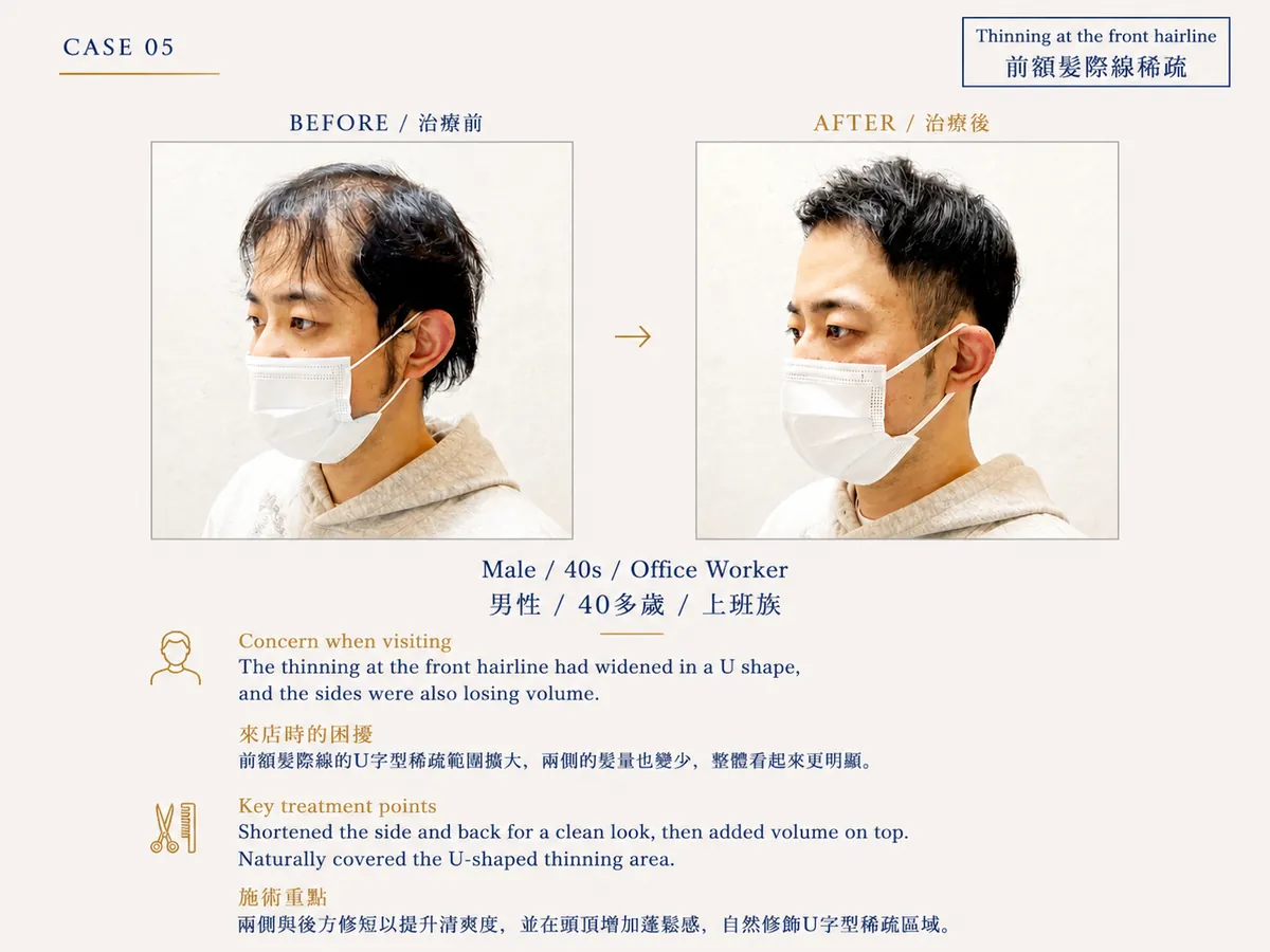 改造案例 CASE05：前額髮際線稀疏（40代男性）Before / After