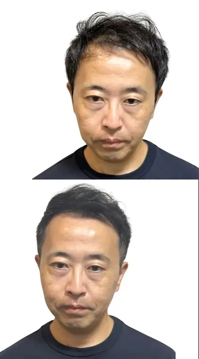 M型禿 × 短髮｜RELIVE JAPAN 頭髮稀疏專門剪髮案例