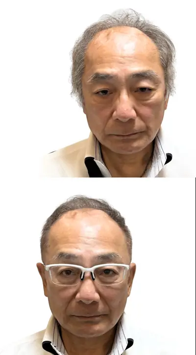 U型禿 × 超短髮｜RELIVE JAPAN 頭髮稀疏專門剪髮案例