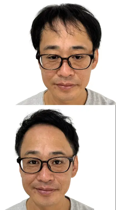 M型禿 × 上梳瀏海｜RELIVE JAPAN 頭髮稀疏專門剪髮案例