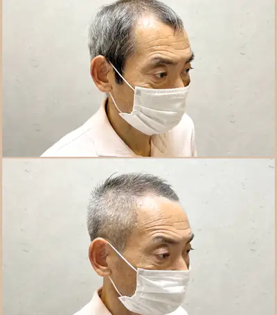 U型禿 × 頭頂立體短髮｜RELIVE JAPAN 頭髮稀疏專門剪髮案例