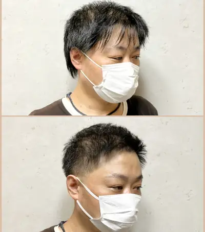M型禿（透光瀏海） × 上梳瀏海｜RELIVE JAPAN 頭髮稀疏專門剪髮案例