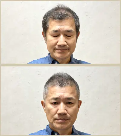 地中海禿 × 超短髮｜RELIVE JAPAN 頭髮稀疏專門剪髮案例