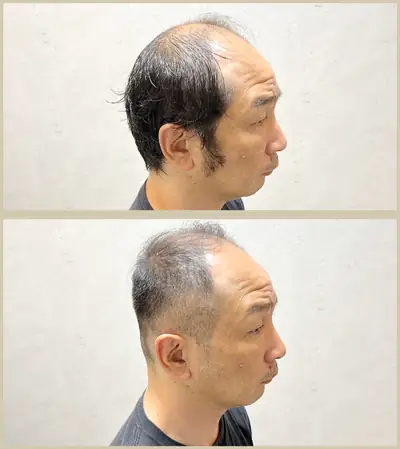 U型禿 × 推剪｜RELIVE JAPAN 頭髮稀疏專門剪髮案例