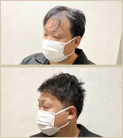 U型禿 × 超短髮｜RELIVE JAPAN 頭髮稀疏專門剪髮案例