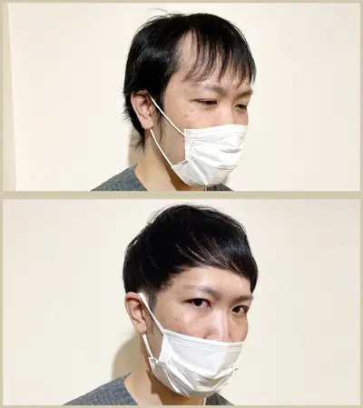 M型禿（透光瀏海） × 兩側推高｜RELIVE JAPAN 頭髮稀疏專門剪髮案例