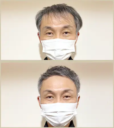 M型禿 × 超短髮｜RELIVE JAPAN 頭髮稀疏專門剪髮案例