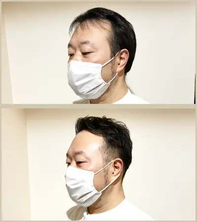 M型禿 × 燙髮｜RELIVE JAPAN 頭髮稀疏專門剪髮案例