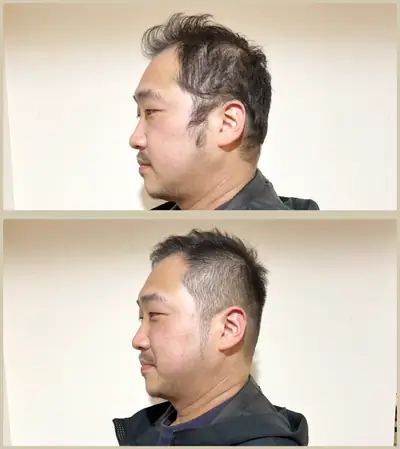 U型禿 × 推剪｜RELIVE JAPAN 頭髮稀疏專門剪髮案例