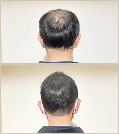 U型禿 × 頭髮稀疏專門剪髮｜RELIVE JAPAN 頭髮稀疏專門剪髮案例