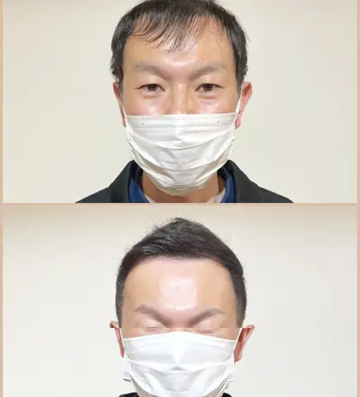 M型禿 × 上梳瀏海｜RELIVE JAPAN 頭髮稀疏專門剪髮案例