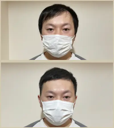M型禿 × 頭髮稀疏專門剪髮｜RELIVE JAPAN 頭髮稀疏專門剪髮案例