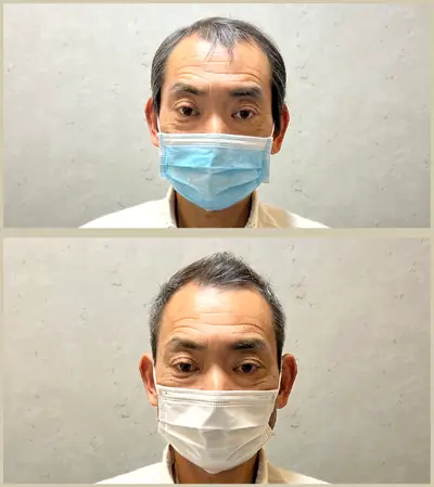 U型禿 × 頭髮稀疏專門剪髮｜RELIVE JAPAN 頭髮稀疏專門剪髮案例
