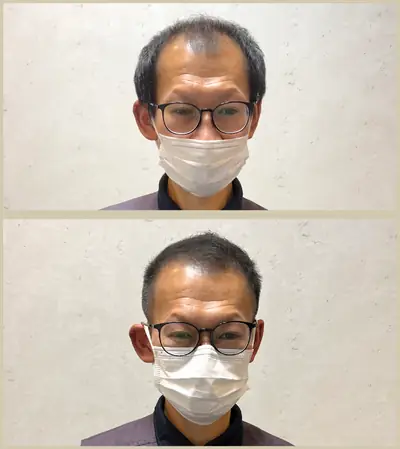 M型禿・U型禿 × 頭髮稀疏專門剪髮｜RELIVE JAPAN 頭髮稀疏專門剪髮案例