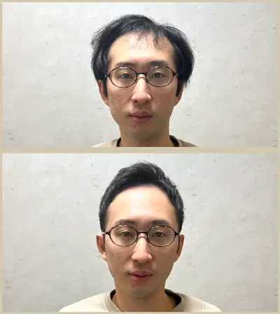 M型禿（透光瀏海） × 上梳瀏海｜RELIVE JAPAN 頭髮稀疏專門剪髮案例