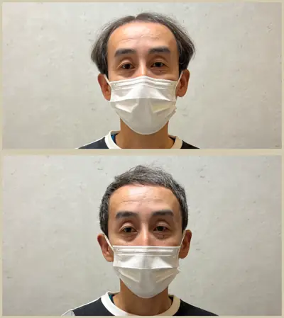 U型禿 × 頭髮稀疏專門剪髮｜RELIVE JAPAN 頭髮稀疏專門剪髮案例